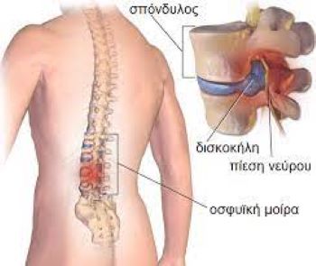 Τι είναι η οσφυαλγία; Αίτια, Συμπτώματα, Αντιμετώπιση